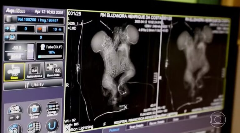 Leia mais sobre o artigo Mãe percorre 670 km pela Amazônia para salvar gêmeas siamesas e celebra sucesso da cirurgia